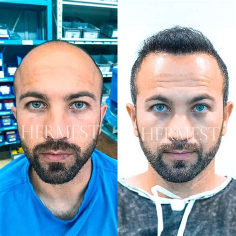 hermest hair transplant yorumları|hermest hair clinic.